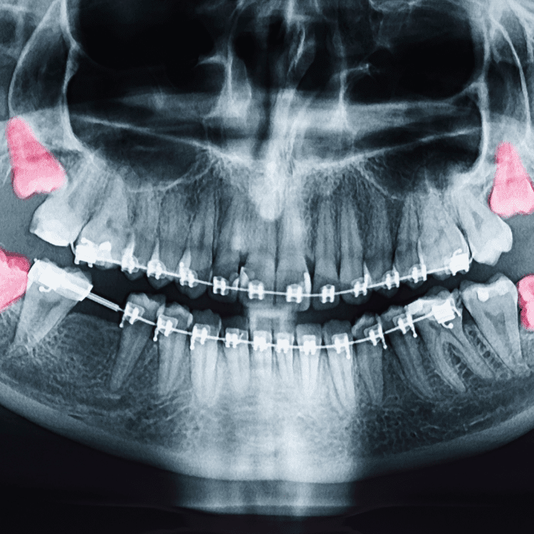 Impacted Wisdom Teeth